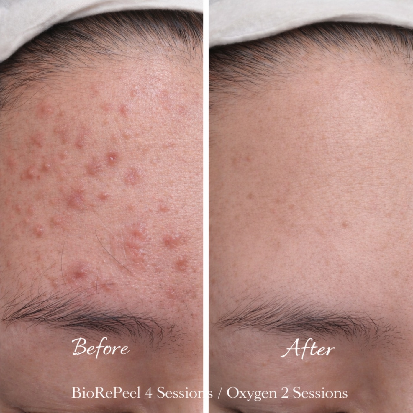 Korean-style facial